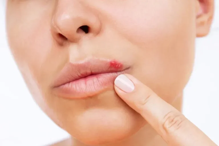 Herpes Photos in Different Stages